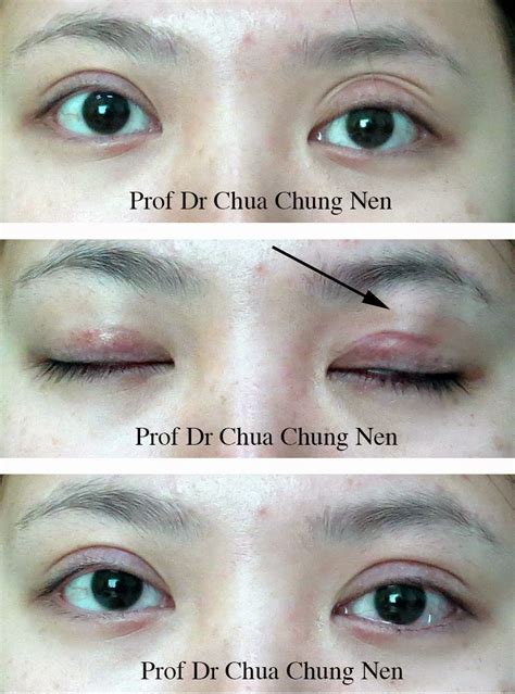 Different optical messages are sent to the brain; Eyelid Surgery by Prof Dr CN CHUA 蔡鐘能: November 2014