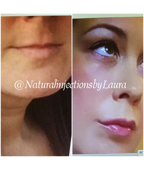 Natural Injections Med Spa By Laura
