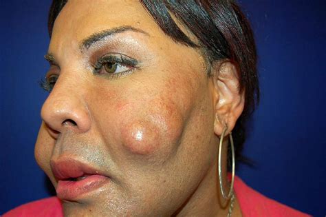15 Extreme Real Life Plastic Surgery Disasters