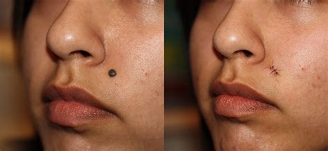 Mole Removal Prices Costs Skin Surgery Laser Clinic
