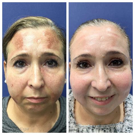 Before And After Medical Spa Pictures Lexington Ky