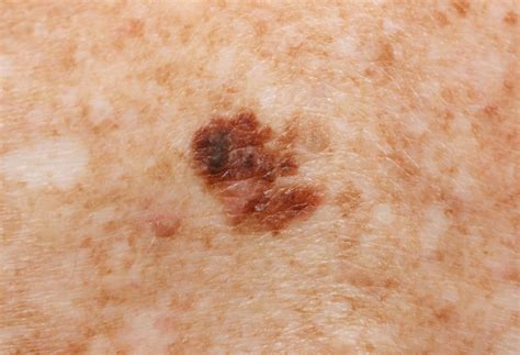Melanoma Pictures By Stages Stage Melanoma Pictures