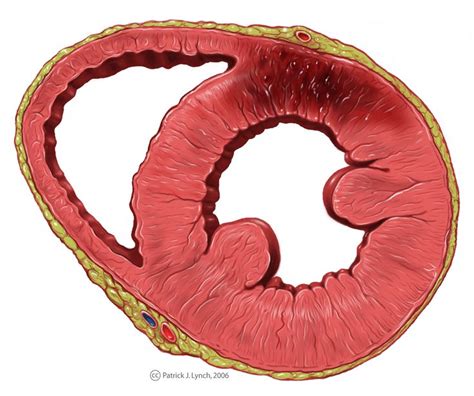 Acute Left Ventricular Wall Infarction Ecgpedia Coronary Artery