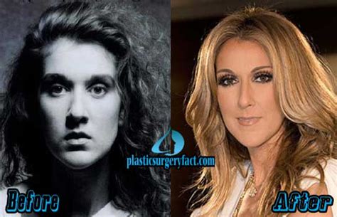 Celine Dion Plastic Surgery Before And After Pictures Plastic Surgery Facts