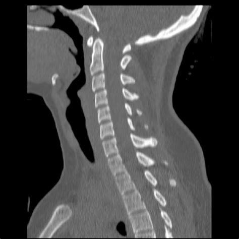 Cervical Spine Computed Tomography Imaging Artifact Affecting Clinical