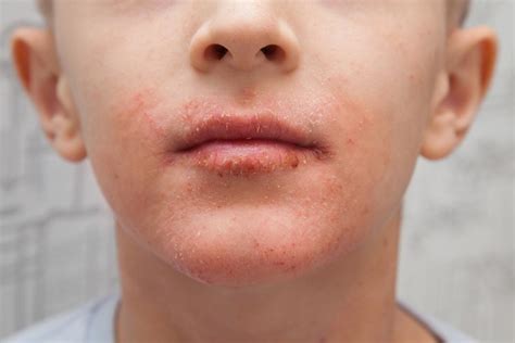 What Can Cause A Rash Around A Childs Mouth Other Allergies
