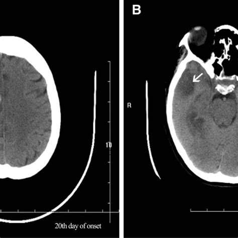 A Ct Scan Of The Brain Showed Multiple Hypodense Lesions White Arrows