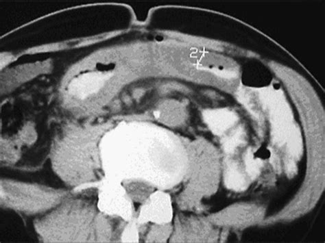 a shift in the diagnostics of the small intestine tumors european journal of radiology