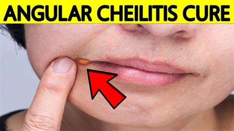 How To Get Rid Of Angular Cheilitis At Home Naturally And Fast Youtube