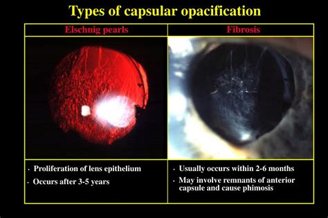 Ppt Complications Of Cataract Surgery Powerpoint Presentation Free Download Id 3000019