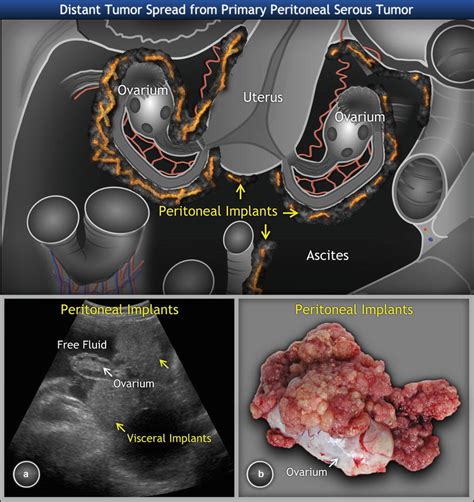 Ovarian Tumors Clinical Setting And Us Radiology Key