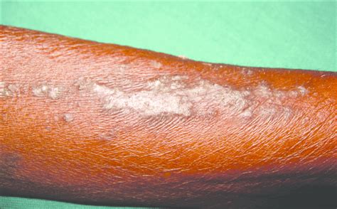 Close View Of The Lesions Showing Erythematous Scaly Plaques Download