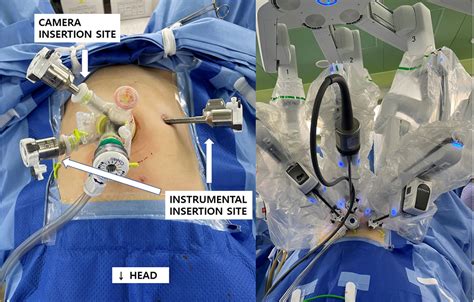 Long Term Outcomes Of Reduced Port Robotic Surgery Rprs For Uterine