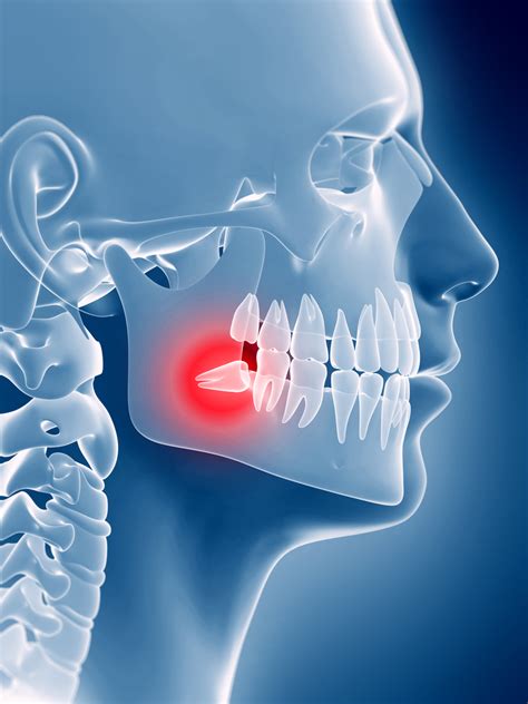 How To Relieve Pain From A Wisdom Tooth Northernpossession24