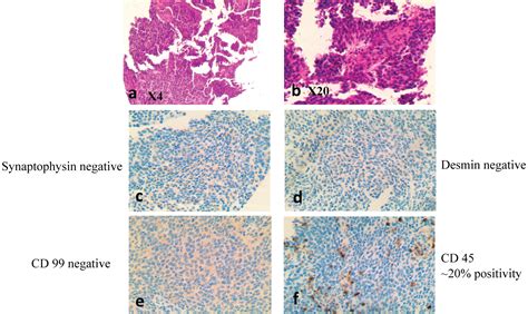 A Review Of The Sub Classification Of Lymph Node Biopsies Reported As