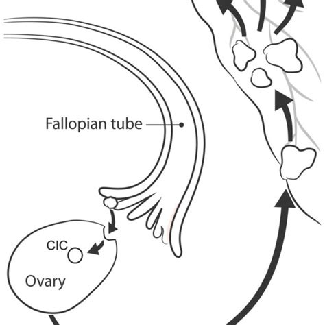 The Hypothesized Progression Of Hgsoc Fte Cells On The Fallopian Tube