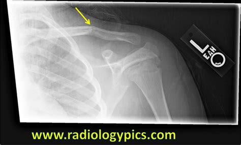 Clavicle Fracture Radiologypicscom