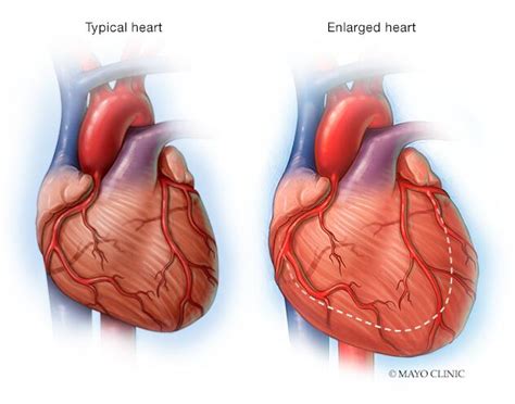 Enlarged Heart Symptoms And Causes Mayo Clinic