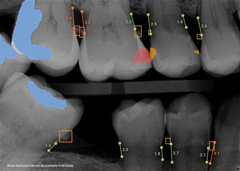 Overjet Expands Dental AI Detection Capabilities With 4th FDA Clearance