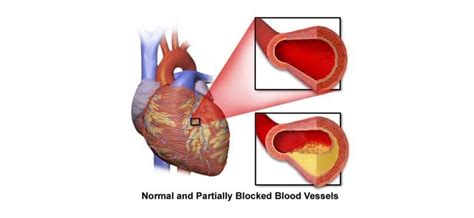 Heart Disease Related To Obesity Cardiovascular Disease
