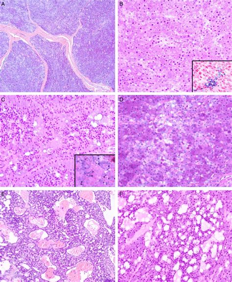 Histologic Spectrum Of Salivary Gland Acinic Cell Carcinoma With