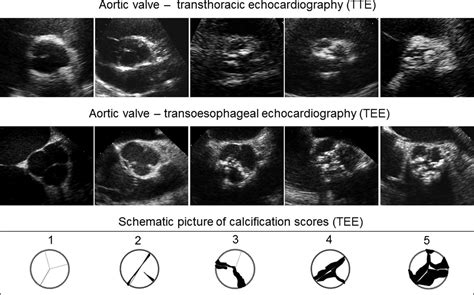 Aortic Valve Type And Calcification As Assessed By Transthoracic And