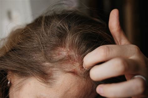 Head Lice Symptoms Causes And Diagnosis Licedoctors Licedoctors