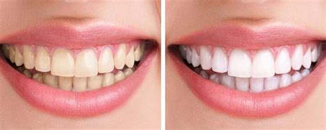 Teeth Whitening In Garstang Staina House Dental Practice Ltd