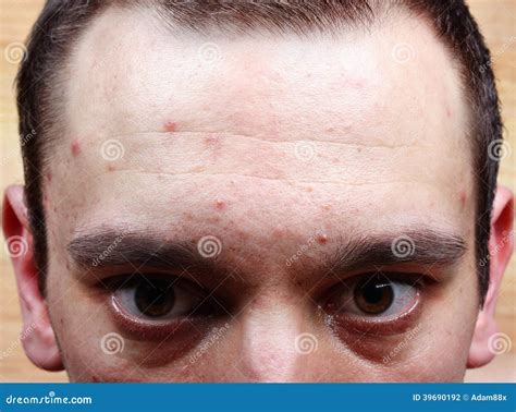 Acne Pimples On The Face Stock Photo Image Of Dermatology 39690192