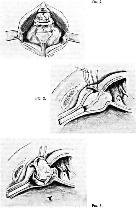 Figure 3 From Anastomosi Cervico Uretrale Dopo Adenomectomia Prostatica