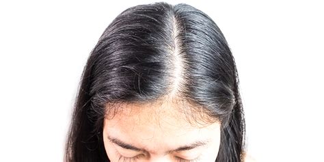 Several factors may give rise to an overgrowth of this yeast, such as excess hair loss is not common in seborrheic dermatitis. How To Remove Excess Sebum From Scalp: Causes And Tips