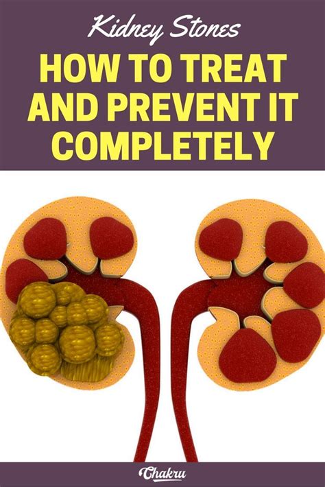 how kidney stones are formed and how to prevent it completely | Kidney stones, Kidney stones ...