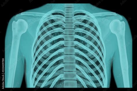X Ray Of The Human Chest The Concept Of Preventive Examination