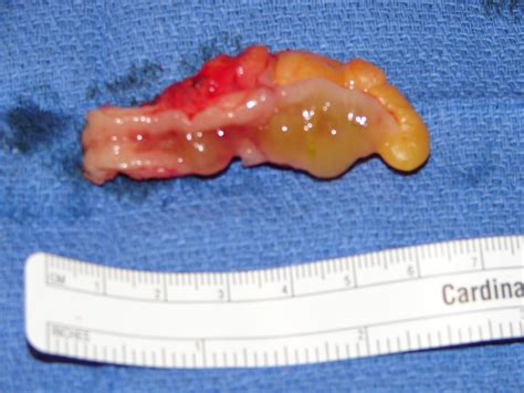 Appendix Neoplasm 1381 Appendix Incidental Mucocele Open Surgery Photos