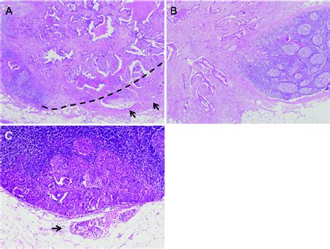 Representative Examples Of Lymph Node Metastasis Patterns A