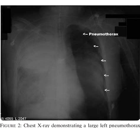 Figure 2 From Pneumothorax From Intrapleural Placement Of A Nasogastric