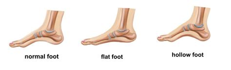 How To Tell If You Have Flat Feet Vionic