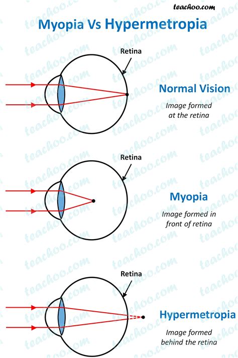 What Is The Difference Between Myopia And Hypermetropia Teachoo