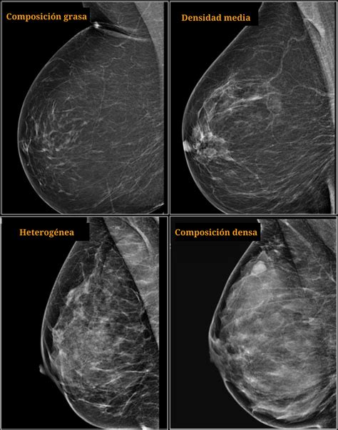 Sistema Bi Rads ¿cómo Se Interpreta Una Mamografía Ondas Y Partículas