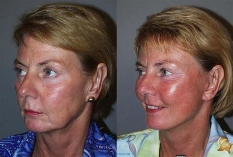 face lift and neck lift before and after photos patient 47 vancouver bc yes medspa and cosmetic