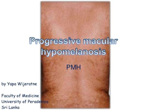 Progressive Macular Hypomelanosis Pmh