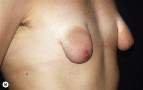 Puffy And Malformed Tits Lovely Areolas Plastic Surgery Pics