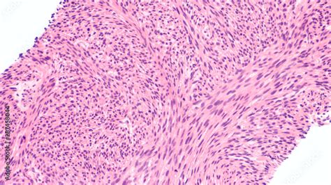 Microscopic Image Of A Leiomyosarcoma A Type Of Soft Tissue Sarcoma Of