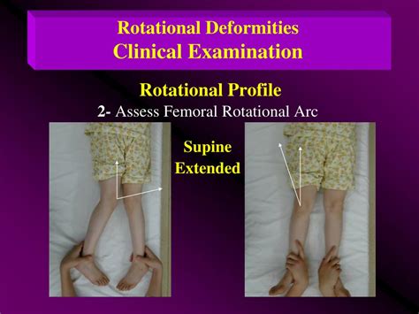 Ppt Angular Deformities Of Ll Bow Legs Knock Knees Rotational