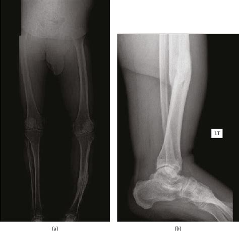 Figure 1 From Total Knee Arthroplasty After Correction Of Tibial