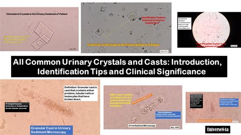 Common Urine Crystals And Casts Introduction Identification Features