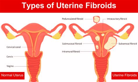 Understanding Uterine Fibroids Causes Symptoms And Treatment Vaidam Health