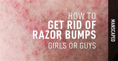How To Get Rid Of Razor Bumps Girls Or Guys Manscaped Blog