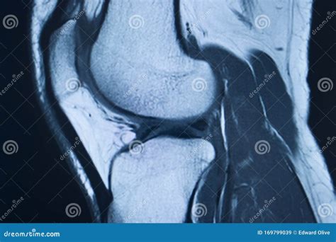 Knee Injury Mri Mcl Tear Stock Image Image Of Medical 169799039