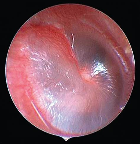 The “spoke Sign” An Otoscopic Diagnostic Aid For Detecting Otitis